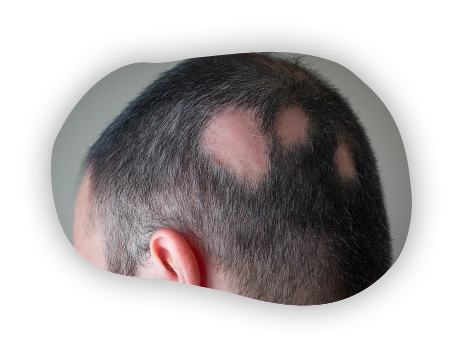 Rear view of a person’s head, with a single coin-shaped bald spot