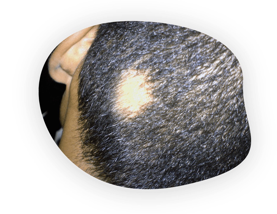 Rear view of a person’s head, with a single coin-shaped bald spot