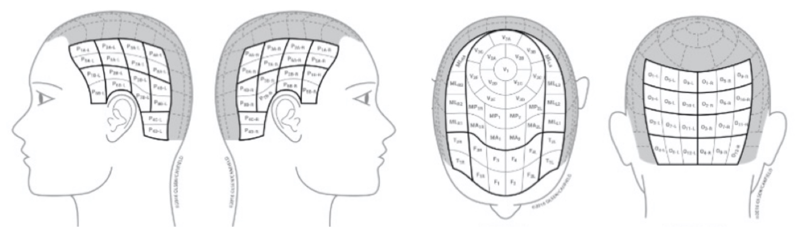 Illustrated left side of a human head, with the left scalp being segmented into different regions depicting 18% of the total scalp area. Right side of a human head, with the right scalp being segmented into different regions depicting 18% of the total scalp area. Back of a human head, with the back scalp being segmented into different regions depicting 24% of the total scalp area. Top of a human head, with the top scalp being segmented into different regions depicting 40% of the total scalp area.