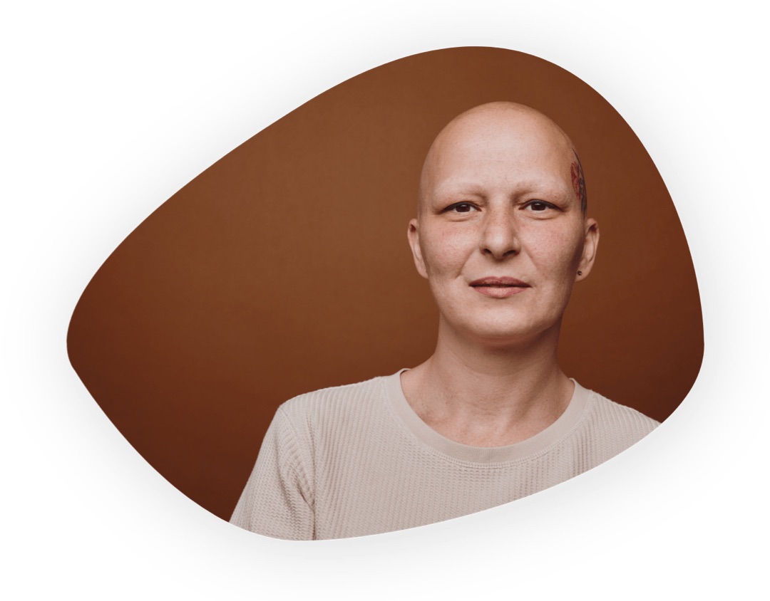 A person with alopecia totalis, no hair on the scalp, eyelashes, eyebrows or face