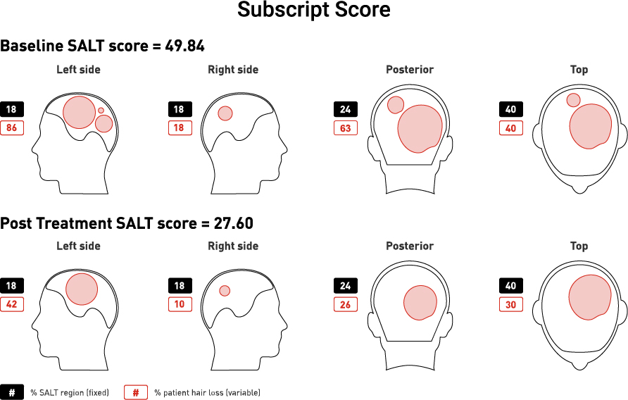 Outline of human head quadrants with circles comparing hair loss pre-and post treatment. Shows baseline SALT score of 49.84 and a post treatment SALT score of 27.60.
