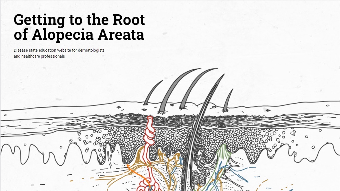Getting to the Root of Alopecia Areata: Disease Education Resources for HCPs